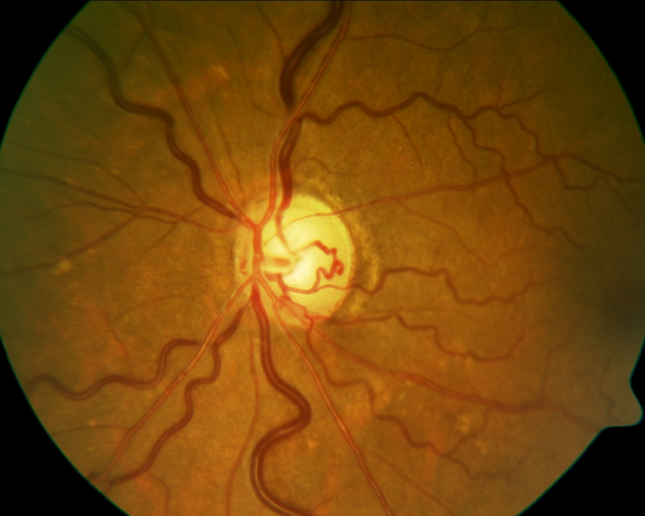 Optic Nerve Evaluation In Glaucoma California Optometric Association